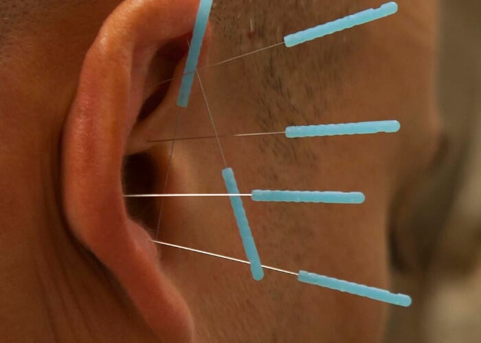 Profs & Pints Baltimore: How Acupuncture Became American